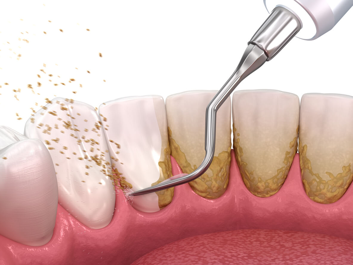 Remove Teeth Tartar