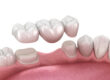 what are dental bridges