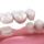what are dental bridges