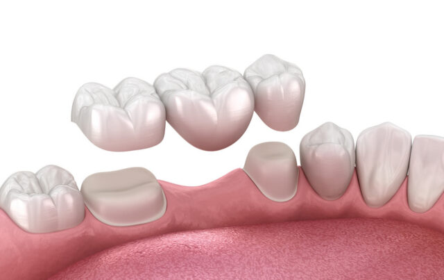 what are dental bridges what are dental bridges