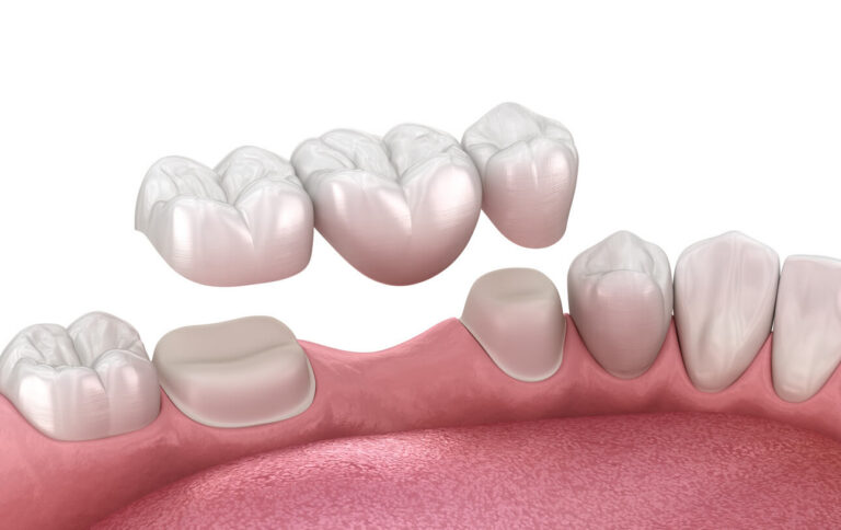 what are dental bridges