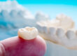 what is dental crown