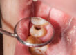 How To Prevent Tooth Decay