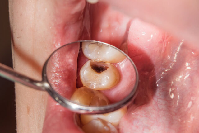 How To Prevent Tooth Decay How To Prevent Tooth Decay